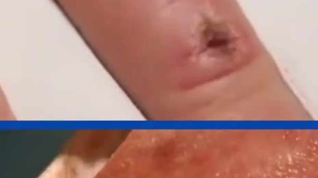 Scientist created self healing skin that can heal 90% in 4 hours