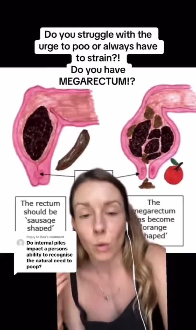 Do you have megarectum?